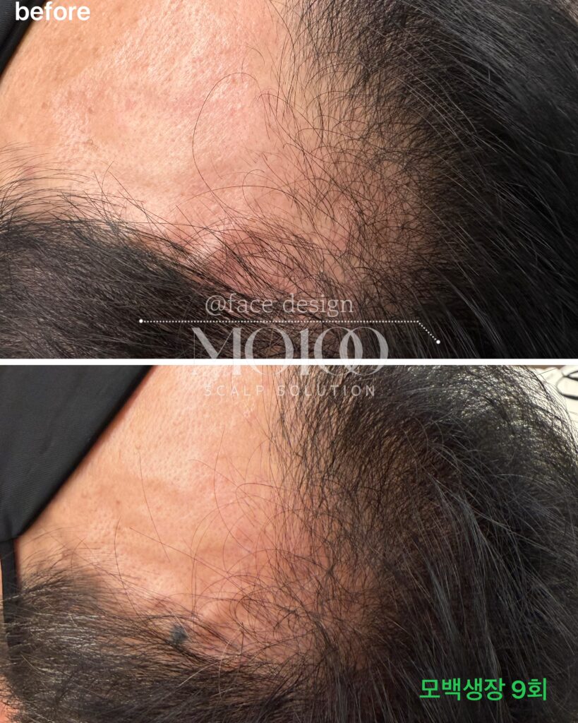 M자 탈모로 헤어라인 두피가 비쳐 보이는 모습