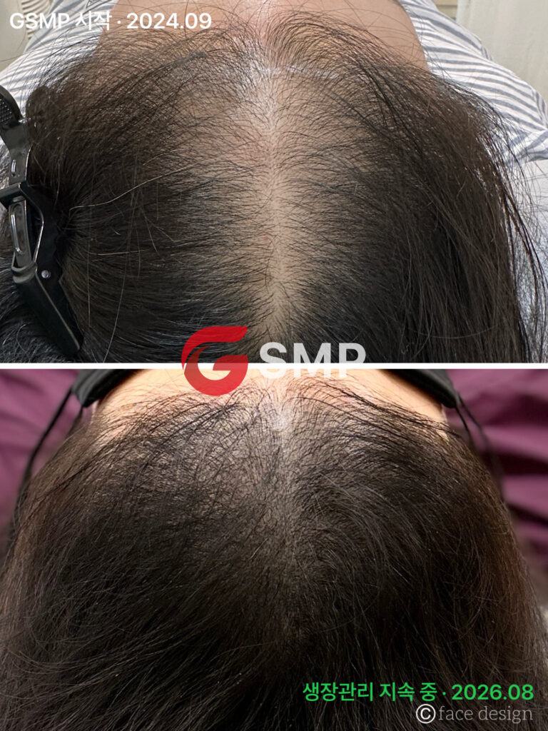대전두피문신 GSMP, 알아두면 좋은 5가지 | 페이스디자인